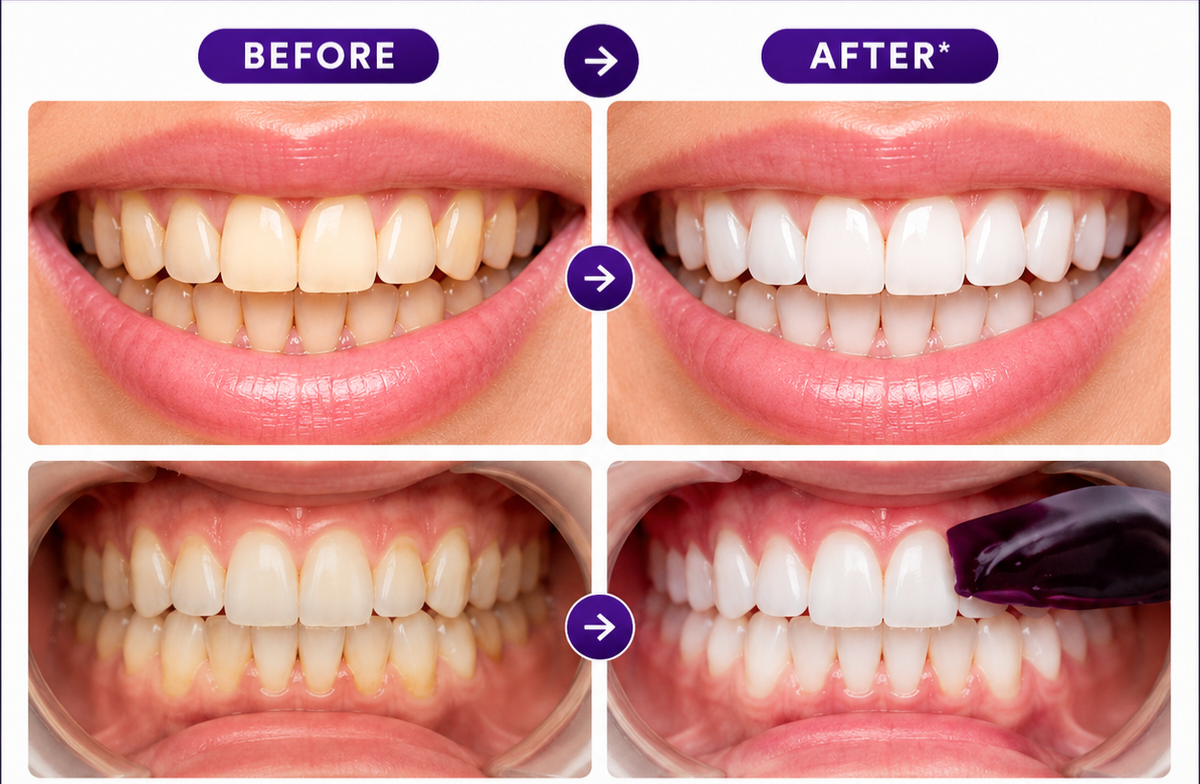 A 2x2 before-and-after comparison showing close-up views of a person's mouth and teeth, with yellowed teeth labeled BEFORE and brighter, whiter teeth labeled AFTER. Purple labels and arrows are used throughout.